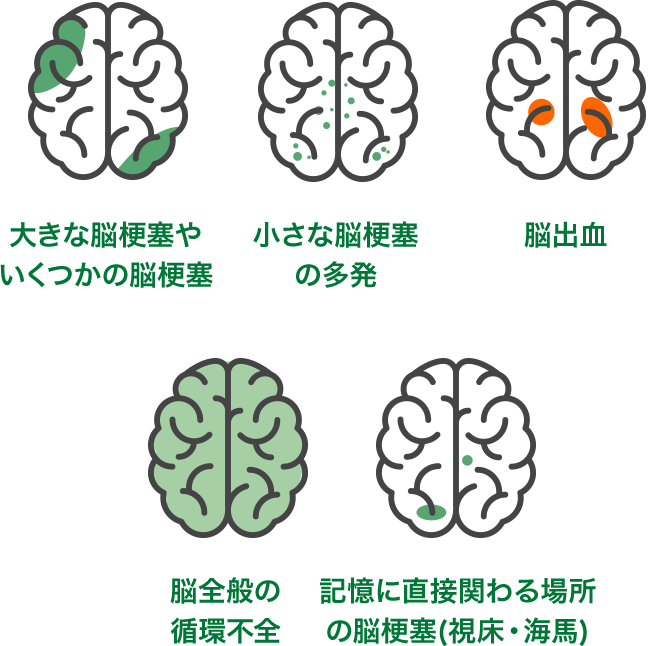 脳血管性認知症の症例